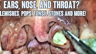 Big Tonsil Stone Removal [upl. by Zoa]