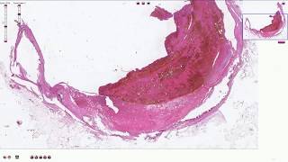 Atheromatous Plaque with Thrombosis  Histopathology [upl. by Woodrow684]