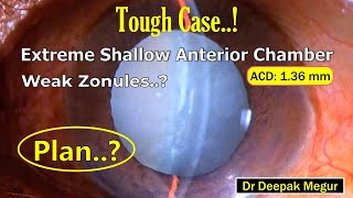 Phacoemulsification Planning for a Tough case Phacomorphic Lens Induced Glaucoma Weak Zonules [upl. by Siramaj]