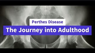 Perthes Disease  The Journey into Adulthood [upl. by Godrich4]