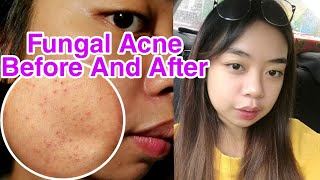 FUNGAL ACNE  Before And After Treatment [upl. by Khai]