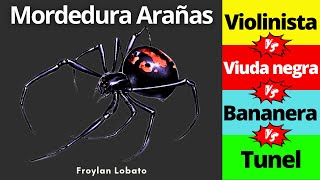 Picadura de araña 🕷️ Diagnóstico y Tratamiento  Violinista Viuda negra Bananera [upl. by Noraed]