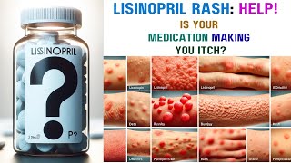 Lisinopril Rash Causes Symptoms and Relief [upl. by Eimiaj]