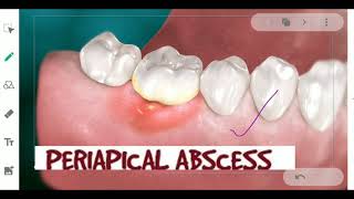 PERIDONTAL PERIAPICAL ABSCESS  GINGIVAL ABSCESS [upl. by Jill194]