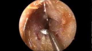 Ear Wax Cerumen Removal in HD [upl. by Carol-Jean]