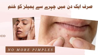 How to remove pimples naturally and permanently [upl. by Lemire]