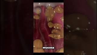 helicobacter pylori infection [upl. by Laureen]