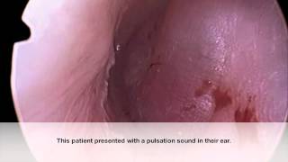 Middle Ear Paraganglioma Glomus Tumor Endoscopy  Dr Nirmal Patel [upl. by Awahsoj]