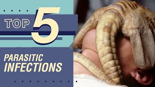 TOP 5 Parasitic Infections [upl. by Constant]