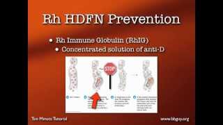 Dosing Rh Immune Globulin [upl. by Eastman]