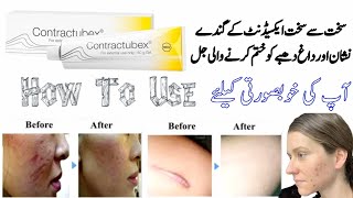 contractubex  contractubex gel  contractubex gel how to use  contractubex gel for acne scars [upl. by Solana605]