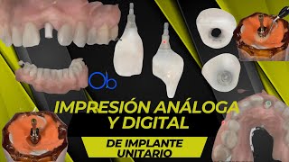 Impresión analógica y digital de implante unitario [upl. by Nelg]