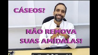 Você tem CÁSEOS Não REMOVA suas AMÍDALAS [upl. by Dlaner61]