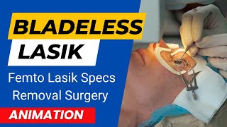 Bladeless LASIK  Femto Lasik Specs Removal Surgery  Bladeless Lasik Eye Surgery Animation [upl. by Lewis]