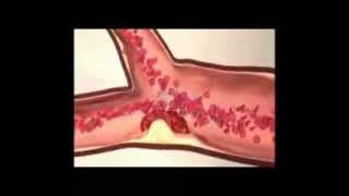 Trombus Formation and Fibrinolysis [upl. by Aicilav]