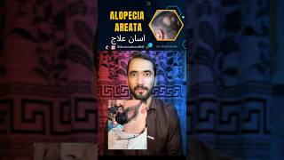 Alopecia Ateata treatment doctor dradnankhan alopecia alopeciaareata [upl. by Cuda]