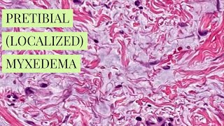 Pretibial localized myxedema explained by a dermatopathologist unknown 12 dermpathiseasy [upl. by Ruelle]