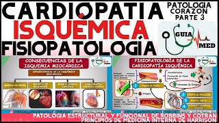 CARDIOPATÍA ISQUÉMICA FISIOPATOLOGÍA  GuiaMed [upl. by Donavon770]