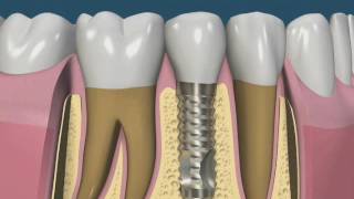 Trauma Oclusal em Implantes  Odontologia [upl. by Eslehc]