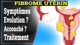 Fibrome Utérin Symptômes Causes Traitement  Gynécologie [upl. by Iretak811]