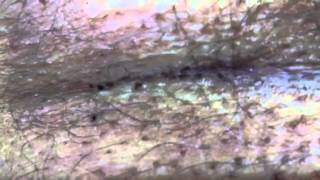 Pediculosis pthyris  body louse [upl. by Livingston]