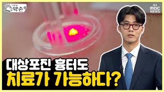 대상포진 여드름 켈로이드 흉터에 관한 궁금증 마음의 상처까지 치유 흉터의 치료와 관리 ⑬  메디컬 약손 [upl. by Kristopher505]