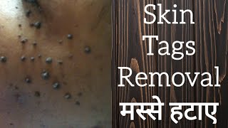 Face Scars Skin Tag Mole Removal  KAYAKALP  Punjabi [upl. by Yursa81]