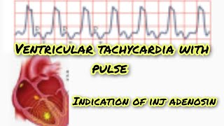 ventricular tachycardia with pulse [upl. by Darcia256]