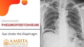 Case Discussion  Pneumoperitoneum  Gas Under the Diaphragm [upl. by Corrinne]