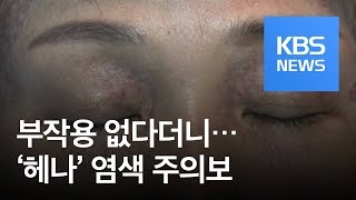 “염색 후 얼굴 까맣게 됐어요”…‘헤나’ 염색 주의보  KBS뉴스News [upl. by Lobiv]