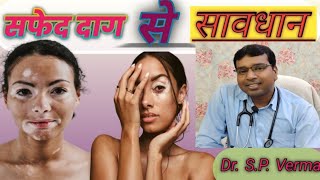 सफेद दाग  VITILIGO [upl. by Rockey]