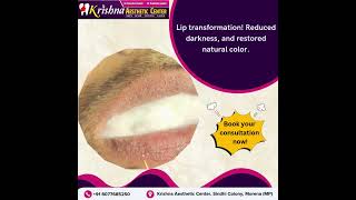 Laser Lip Resurfacing lipresurfacing laserliptreatment lasertreatment lasertreatmentclinic [upl. by Pattin]