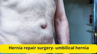 Hernia repair surgery umbilical hernia [upl. by Loziram829]