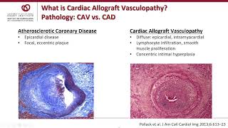 Cardiac Allograft Vasculopathy CAV  Weekly Research Conference with Sharon Chih MD PhD [upl. by Darrej]