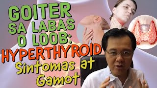 Goiter sa Labas o Loob Hyperthyroid Sintomas at Gamot  Payo ni Doc Willie Ong 212 [upl. by Arev]