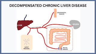 Decompensated Chronic Liver Disease Explained [upl. by Nedah]