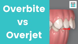 OVERBITE VS OVERJET l Dr Melissa Bailey Orthodontist [upl. by Norramic884]