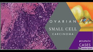 Digital Surgical Pathology 43 Small cell carcinoma of the ovary [upl. by Rosina]