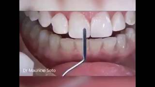 Composite Veneers step by step  All the Secrets [upl. by Myers]