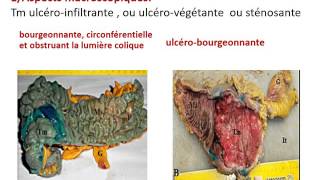 GASTROENTEROLOGIE anapathG cancer colo rectaux 2016 [upl. by Ahsele]