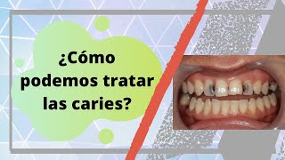 ¿Qué tratamientos hay para las caries  Dr Alvaro Campos [upl. by Iny]