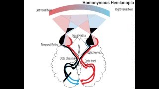 homonemous hemianopia [upl. by Tra]