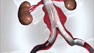 Abdominal Aortic Aneurysm [upl. by Mcclelland264]