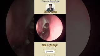 귀지형 콧물 부비동염 축농증 비염 코청소 이비인후과 rhinorrhea rhinitis sinusitis asmr ENT entdoctor [upl. by Nuahsad]