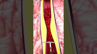 How Heart Stents Work 🤔 [upl. by Ivek896]