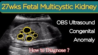 27wks Fetal Multicystic Kidney  OBS Ultrasound Congenital Anomalies [upl. by Margeaux]