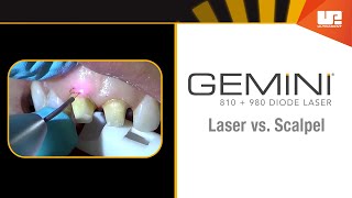 Gemini Clinical – Gingivectomy [upl. by Cormack738]