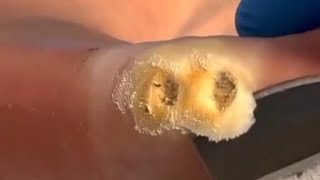 Plantar warts on foot removal  Satisfying [upl. by Oicanata150]