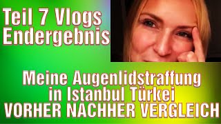 Augenlidstraffung Türkei Erfahrung Lidstraffung Vorhher Nachher Bilder Medical Exclusive Istanbul [upl. by Frere875]