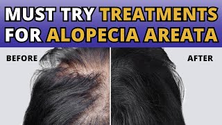 The Best Treatments for Alopecia Areata You Need to Try [upl. by Fulmer154]